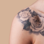 remoção de tatuagem