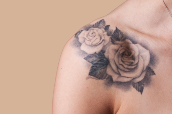 remoção de tatuagem